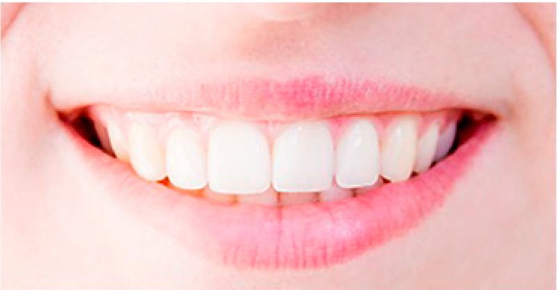 Blanqueamiento dental