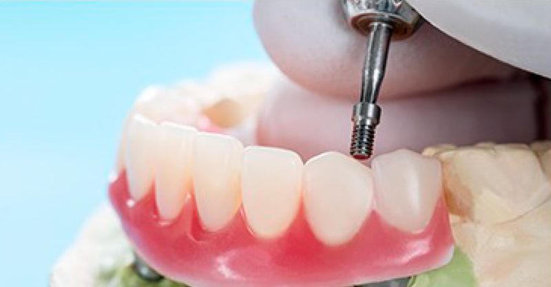 Implantes dentales